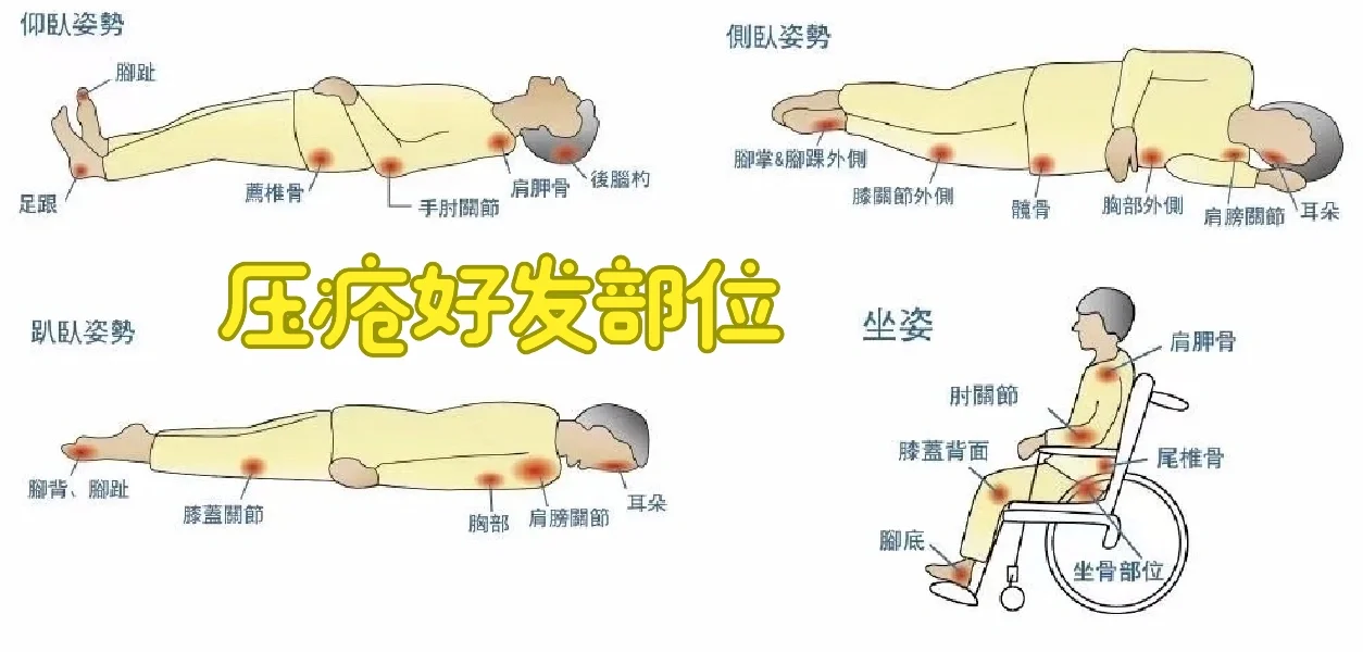压疮好发部位➕评价量表