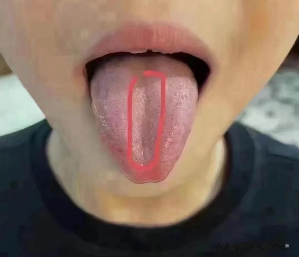 家长们有没有观察过孩子的舌头？
很多孩子，舌头中间有一条深深的凹陷
这种情况中医
