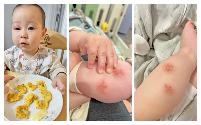 教你 3 招驱蚊止痒，蚊虫退！退！退