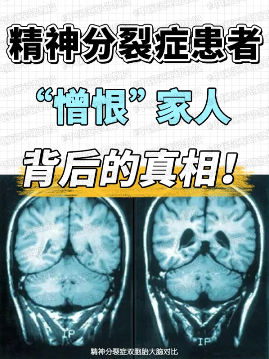 精神分裂症患者，“憎恨”家人，背后的真相！ . 在神志科门诊，很多家属...