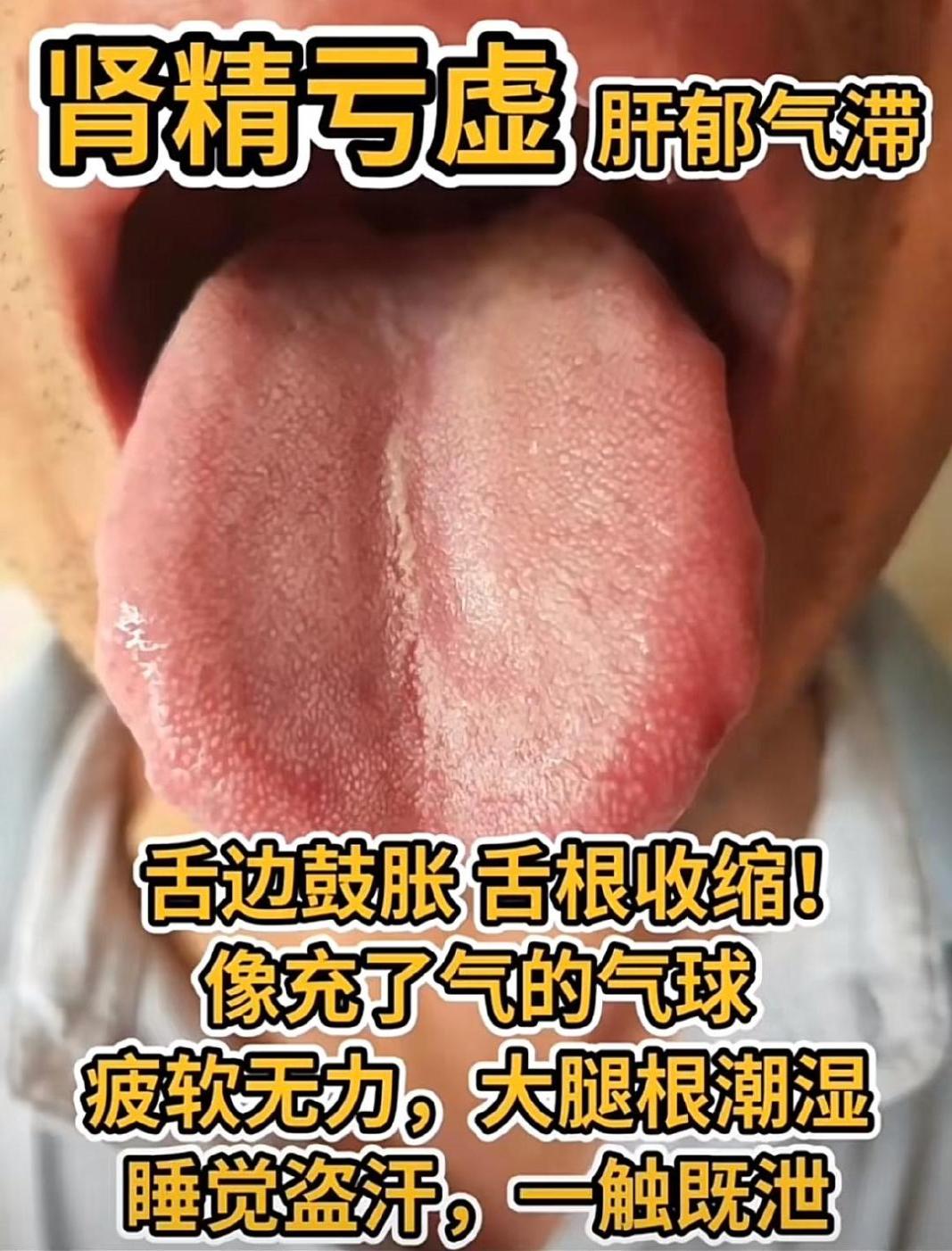 老中医提醒你：肾好不好，看舌头就知道！

前两天又看到一个很经典的肾虚舌象，今天