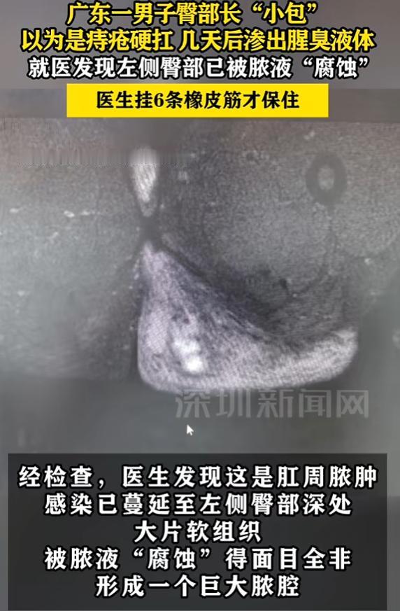 “悲剧还是发生了！”9月12日报道，广东东莞，一男子屁股上长了个小硬块，他以为是