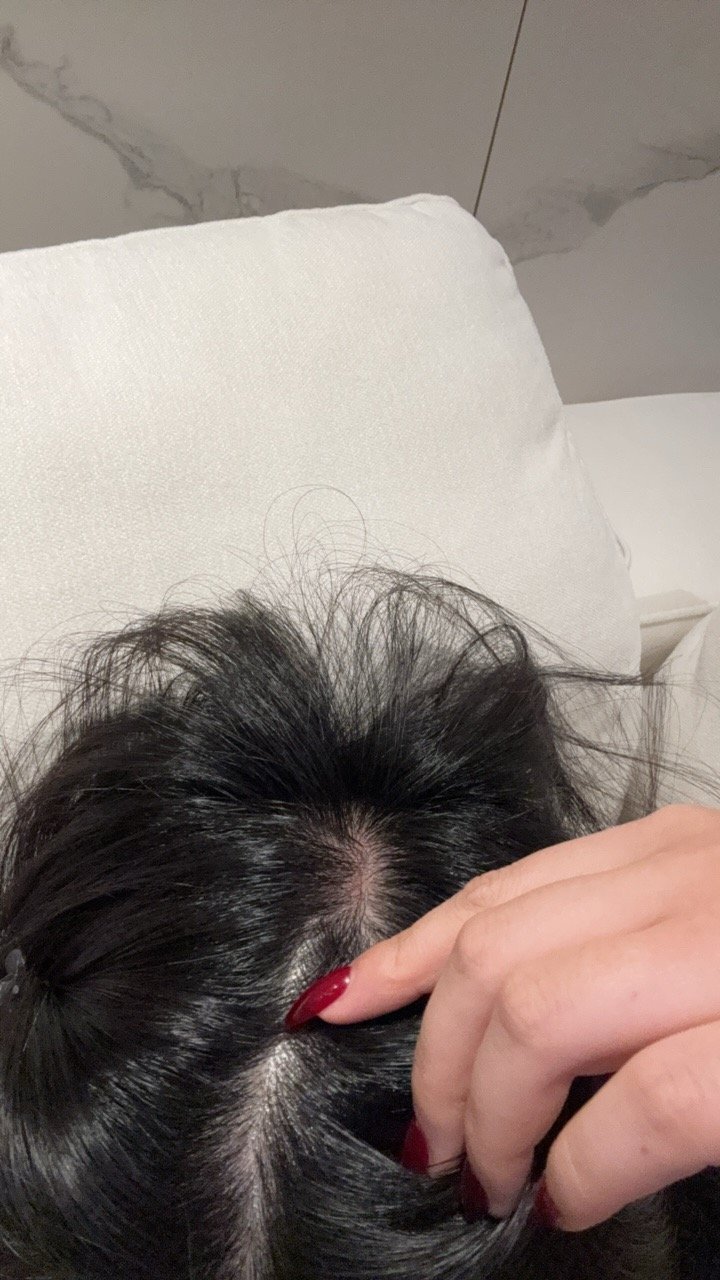 家人们头皮晒伤了怎么办啊 