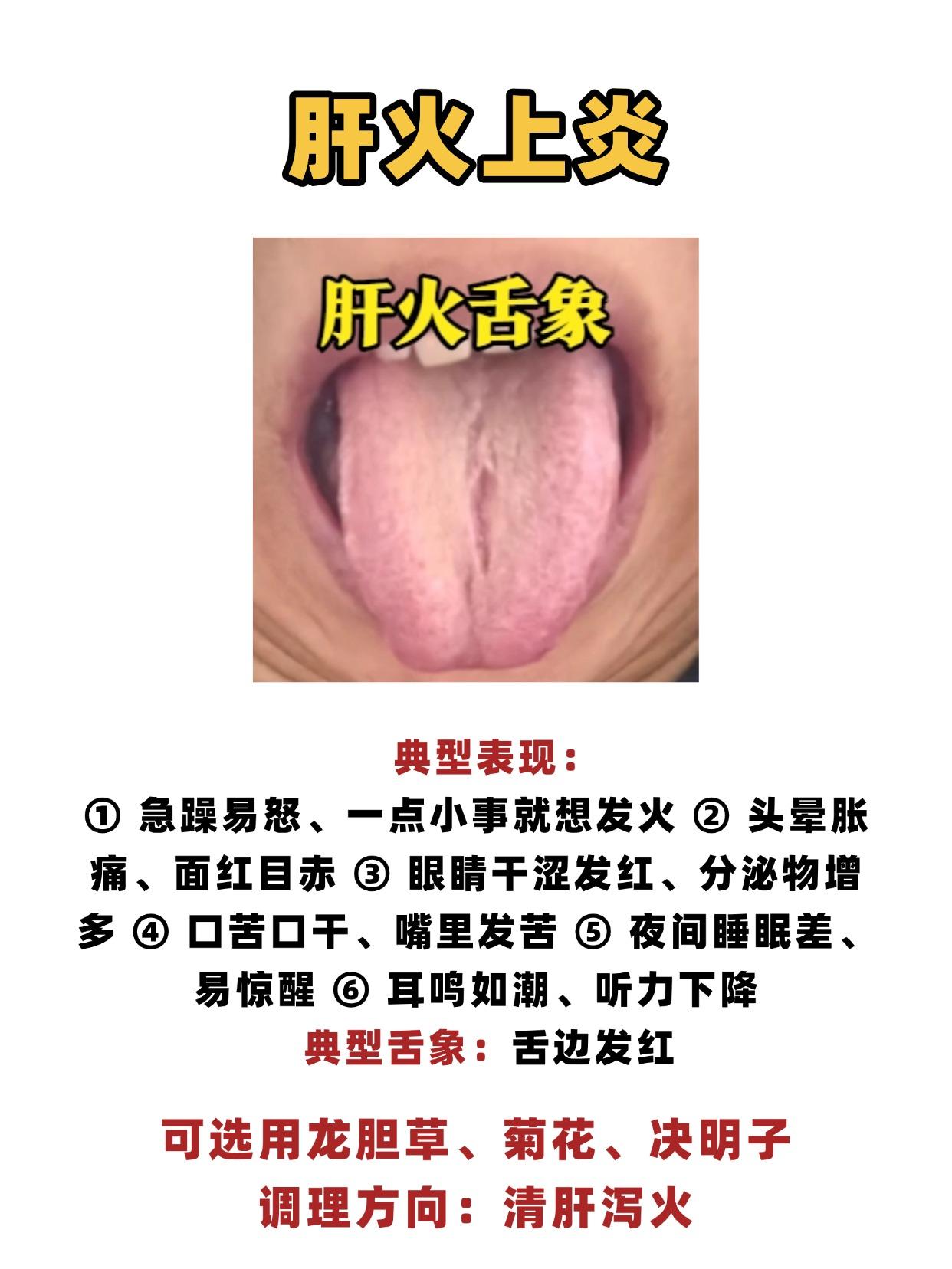 别再乱降火！4 种 “上火” 的对照舌象，对症调理才有效！

一、肝火上炎
典型