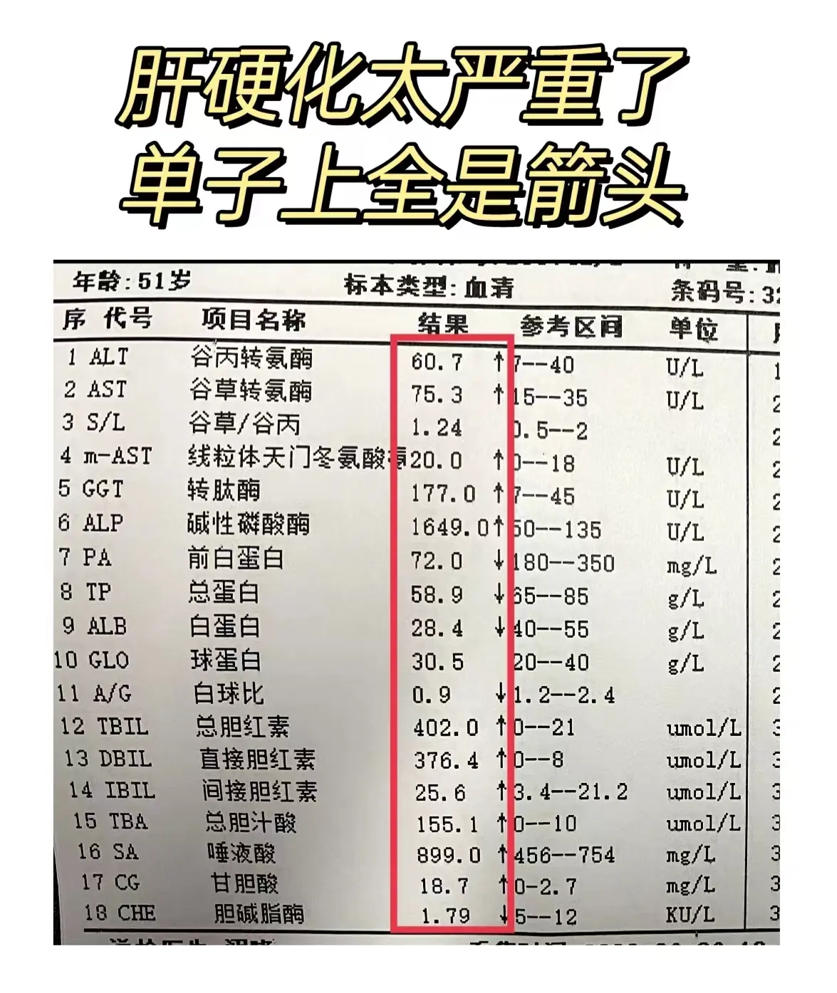 这是一位肝硬化患者的肝功能报告单，患者有十几年的乙肝病史并伴有长期饮酒...