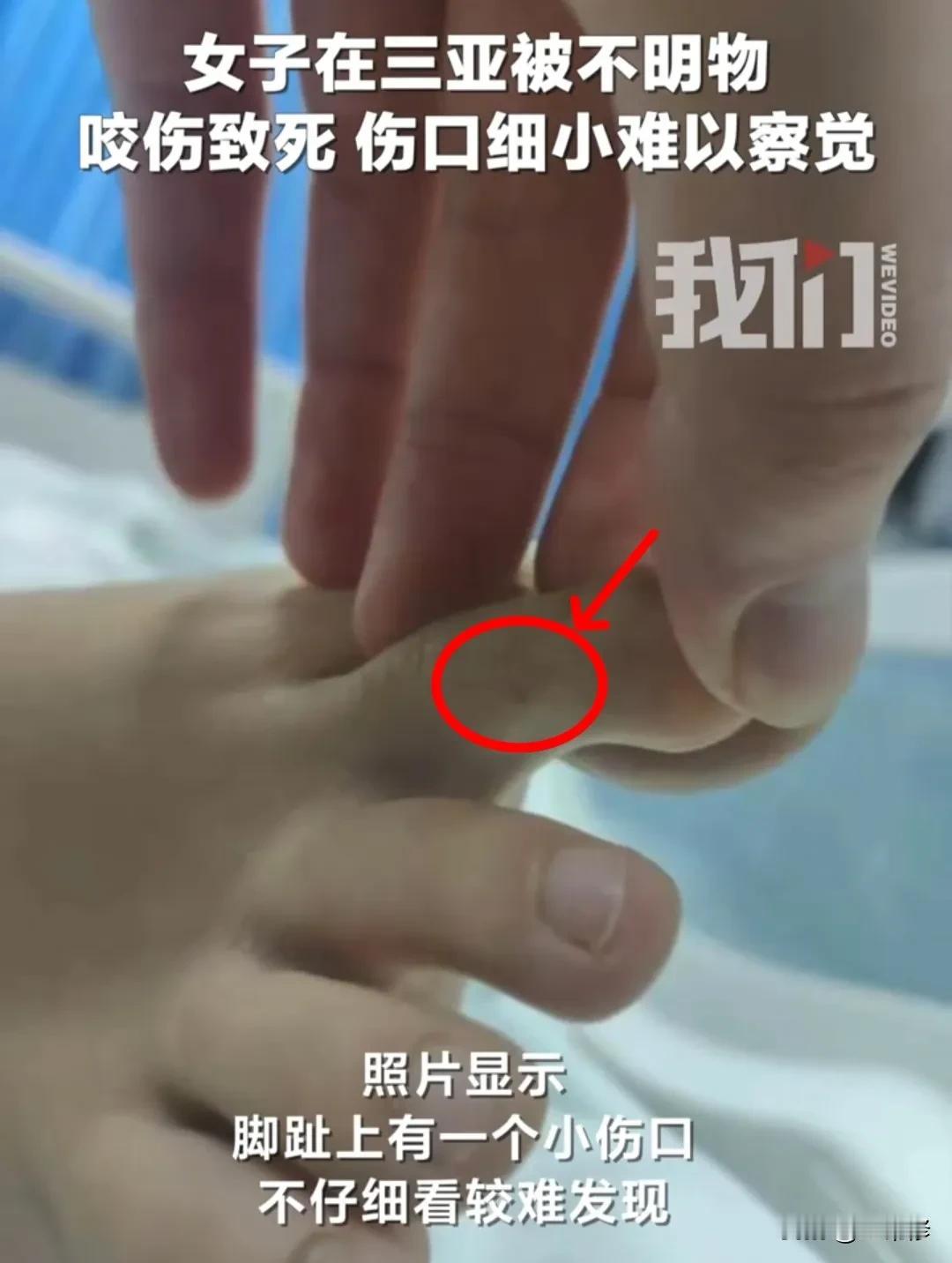 女子三亚旅游被蛇咬身亡这事儿，给每个人上了致命一课！

1，假如说被蛇咬，尽可能