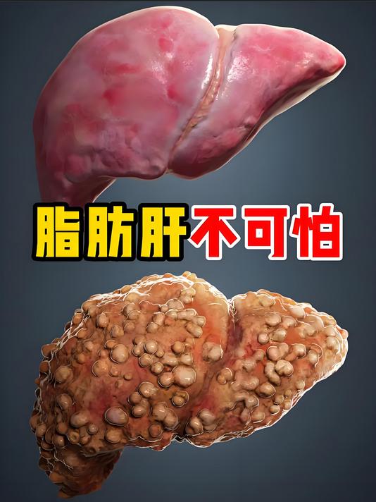 脂肪肝的"消脂方"，我只说一次！赶紧存好

在临床行医的三十余年里，我见过太多人