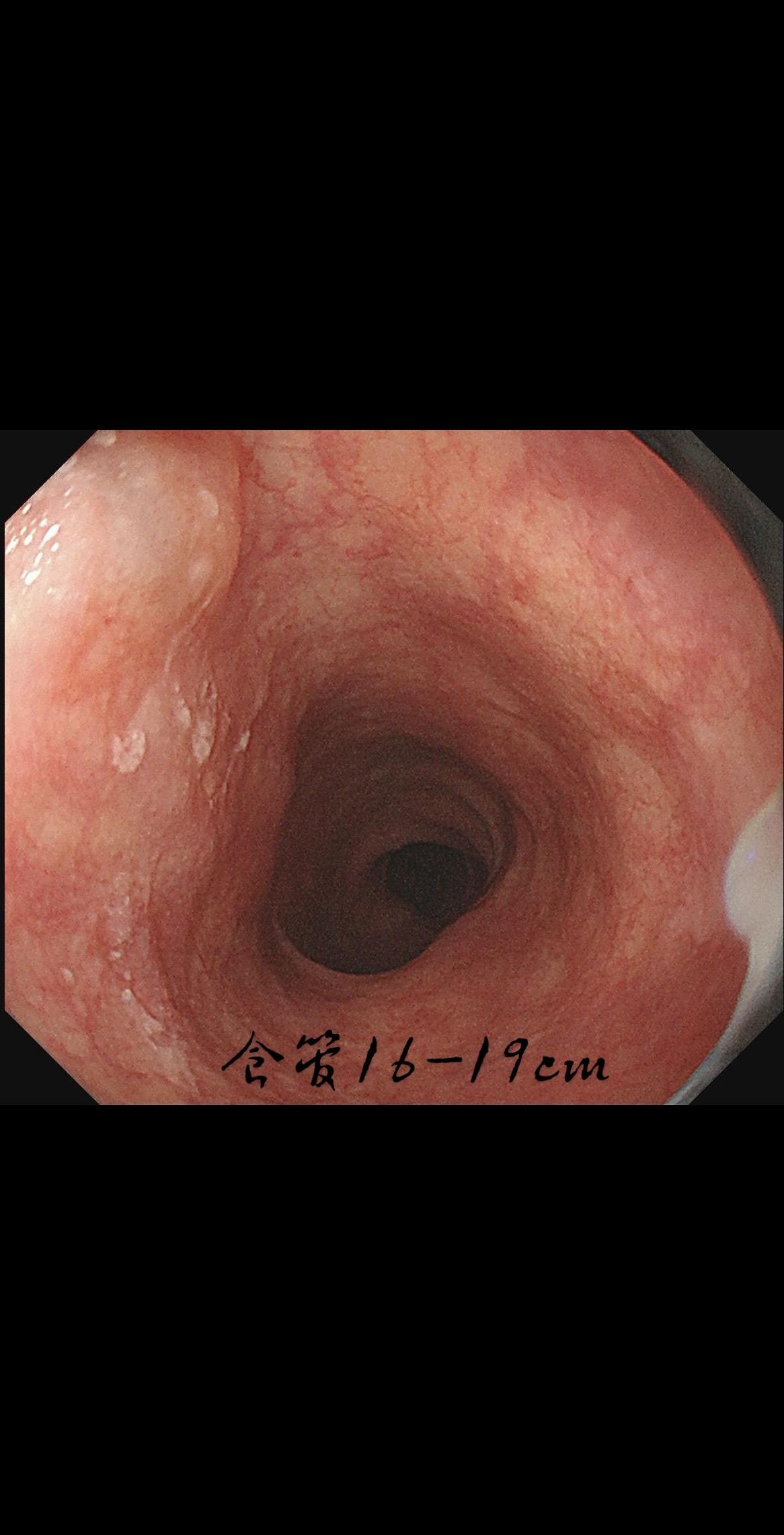 女，73岁，食管双发病变。泰州人，入院系统体检，首次胃镜检查，上段16...