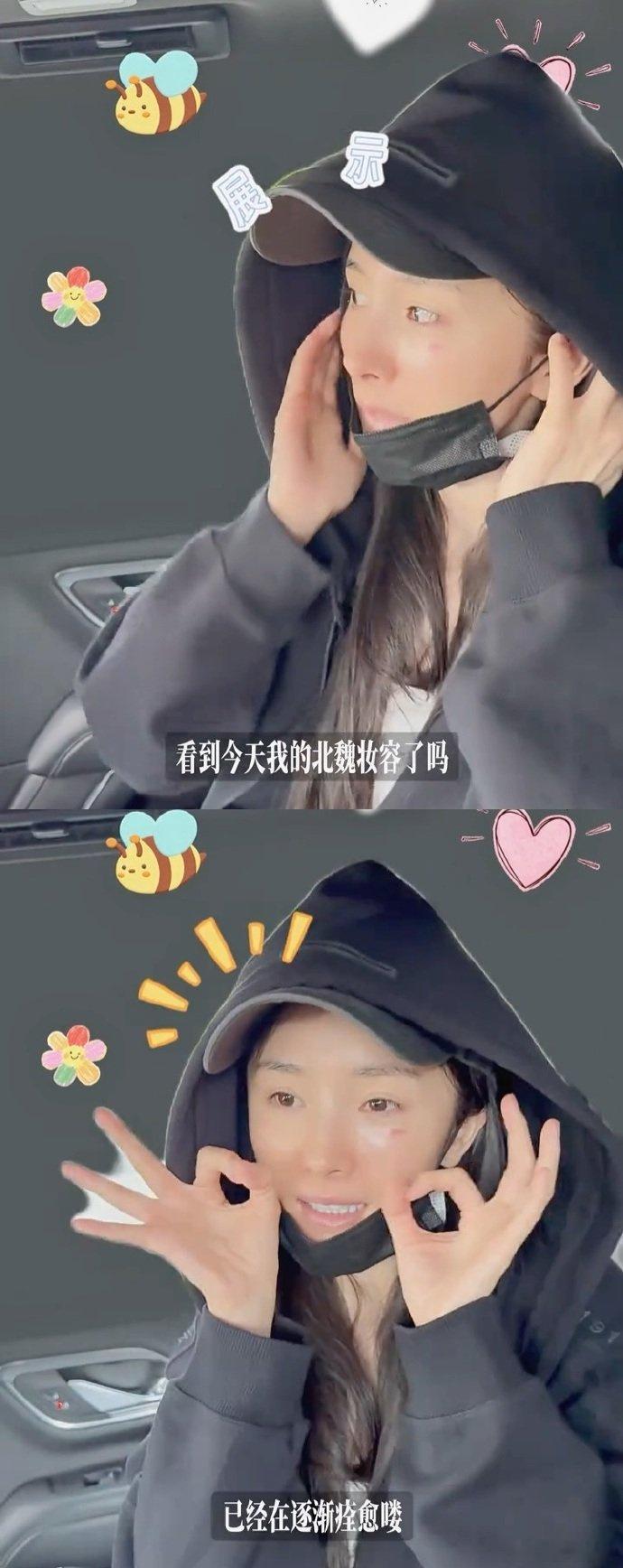 杨幂说烫伤在逐渐痊愈了 杨幂在最新的vlog里说自己脸上的烫伤已经在逐渐痊愈了，