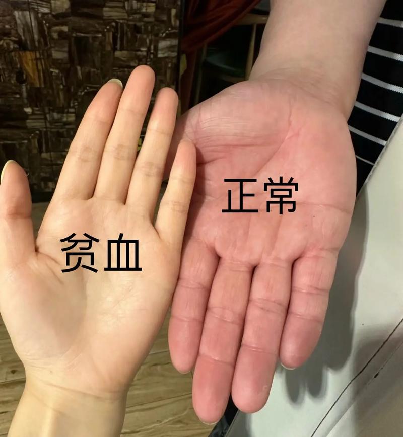 贫血。