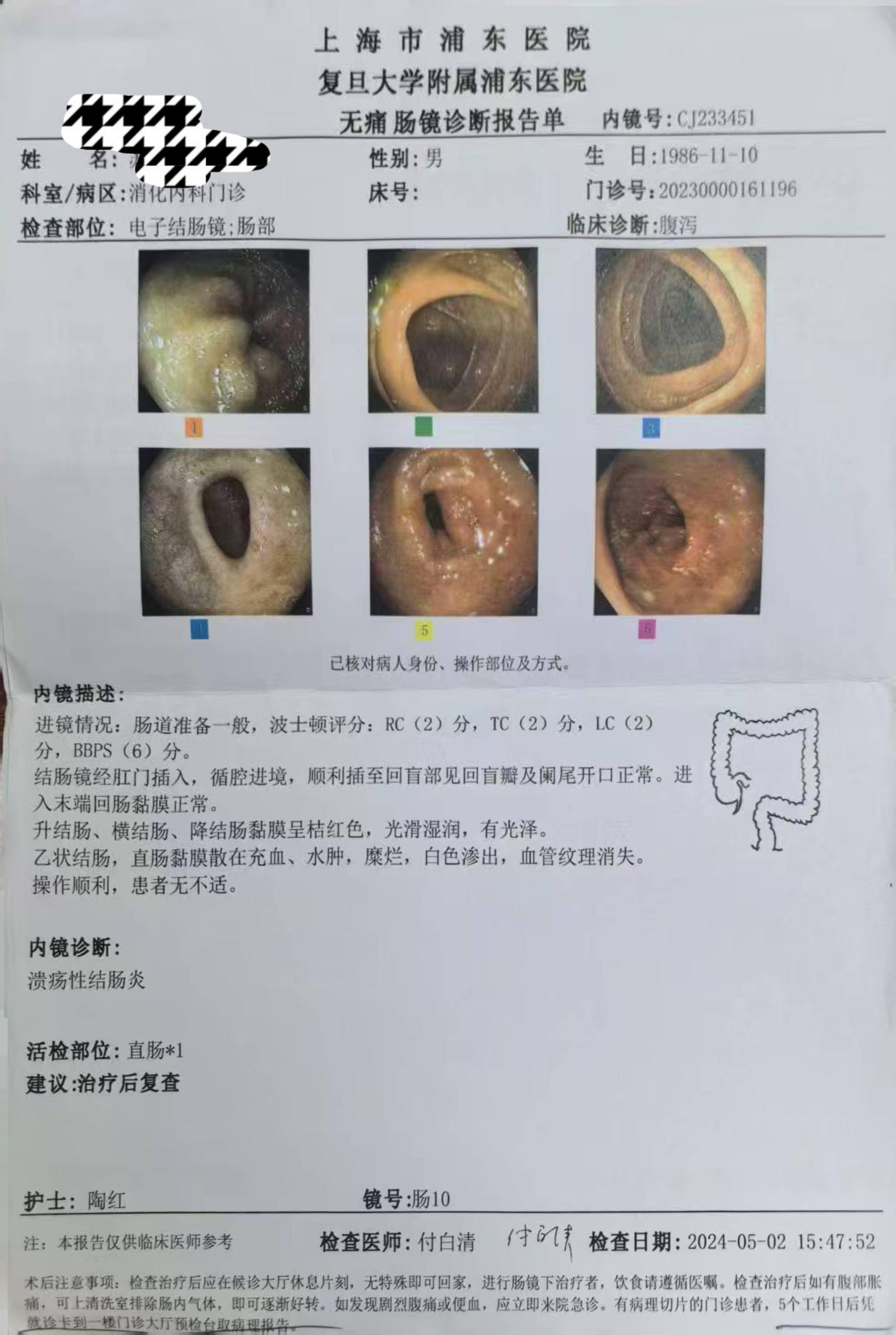 内镜下多发疤痕是溃疡性结肠炎修复的表现。 溃疡性结肠炎的患者，得到有效...