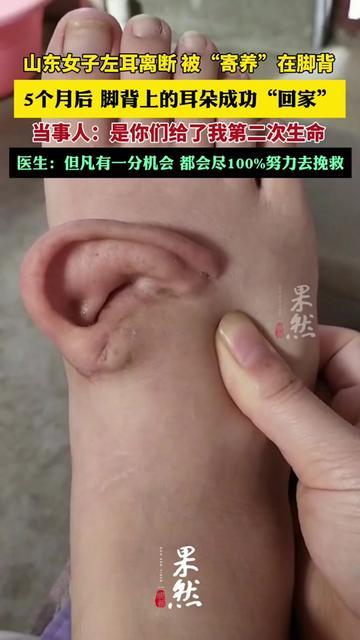 你见过脚背上长耳朵吗？山东一位大姐的左耳，居然在脚背上住了5个月！

去年她