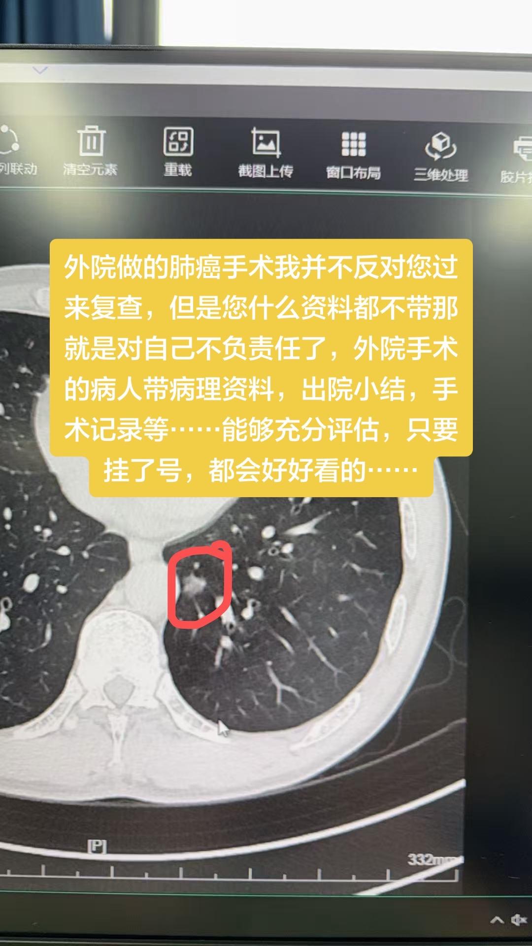 外院做的肺癌手术我并不反对您过来复查，但是您什么资料都不带那就是对自己...