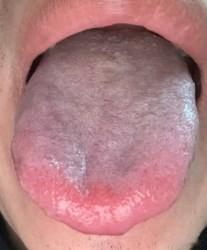 这也是个早泄的患者，看到这种舌头啊，先别急着补肾，可能是“心”病！

病人主诉：