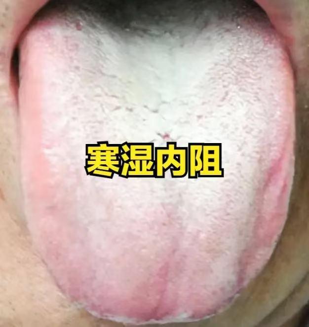 湿缠身体逃不掉重、浊、粘滞！教你对着舌头快速分清寒湿、痰湿、湿热，看舌象对号入座