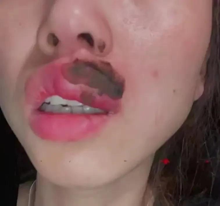 可怕！江苏常州，女子在睡梦中感觉嘴巴一阵刺痛，惊醒后发现自己的嘴巴变成了香肠嘴！