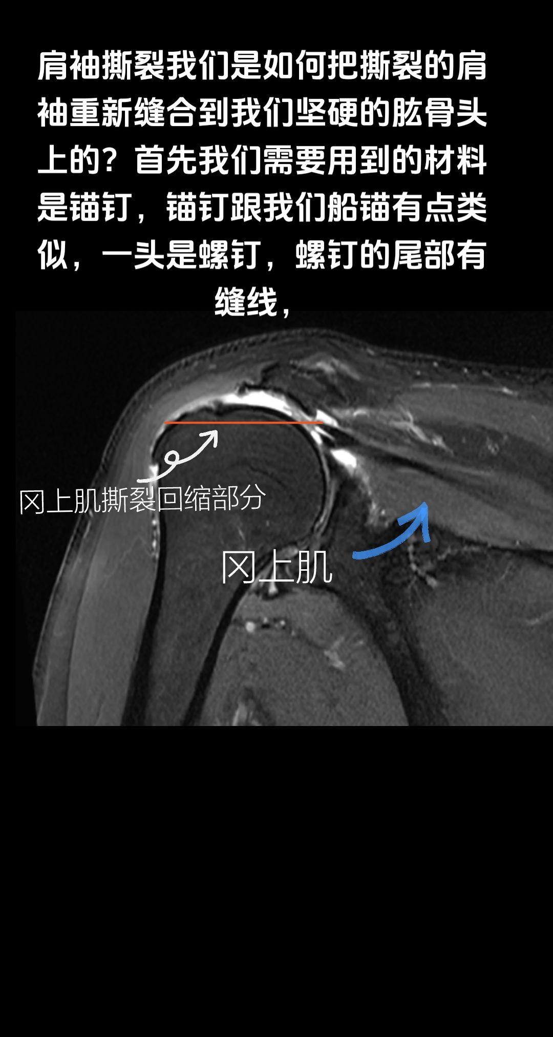 肩袖撕裂是如何缝合的？肩袖撕裂