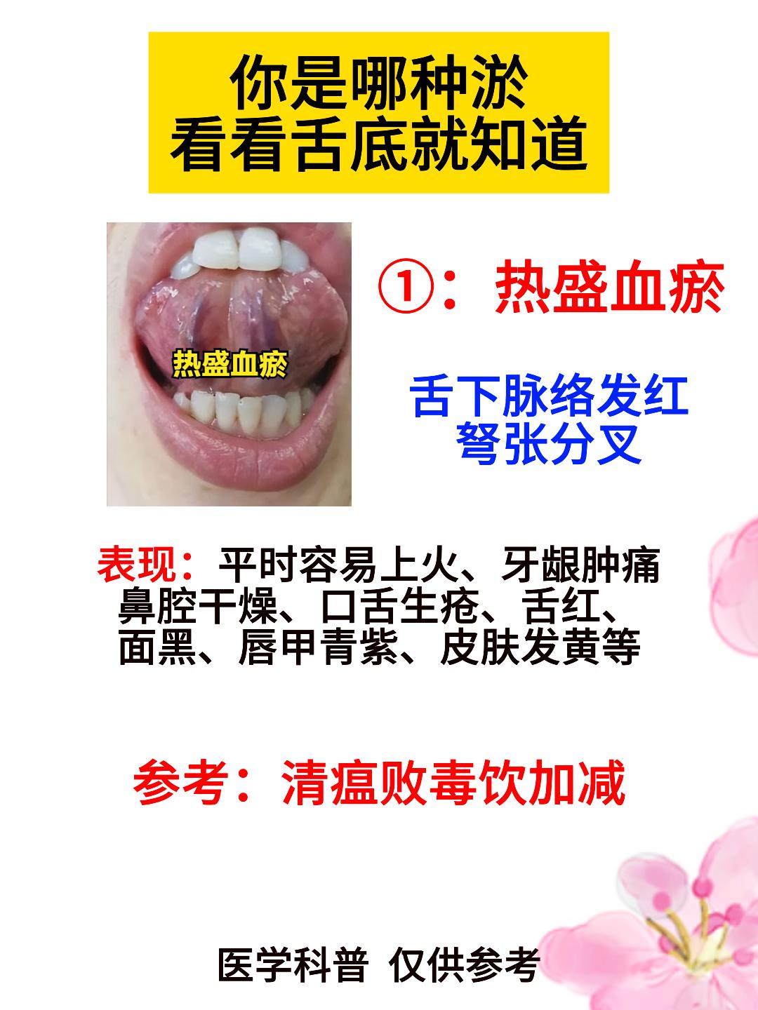 你是 哪种淤？看看舌底就知道[给力][给力][给力]