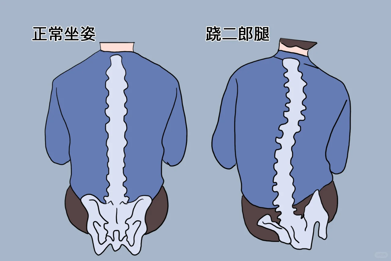 跷二郎腿脊椎变形图