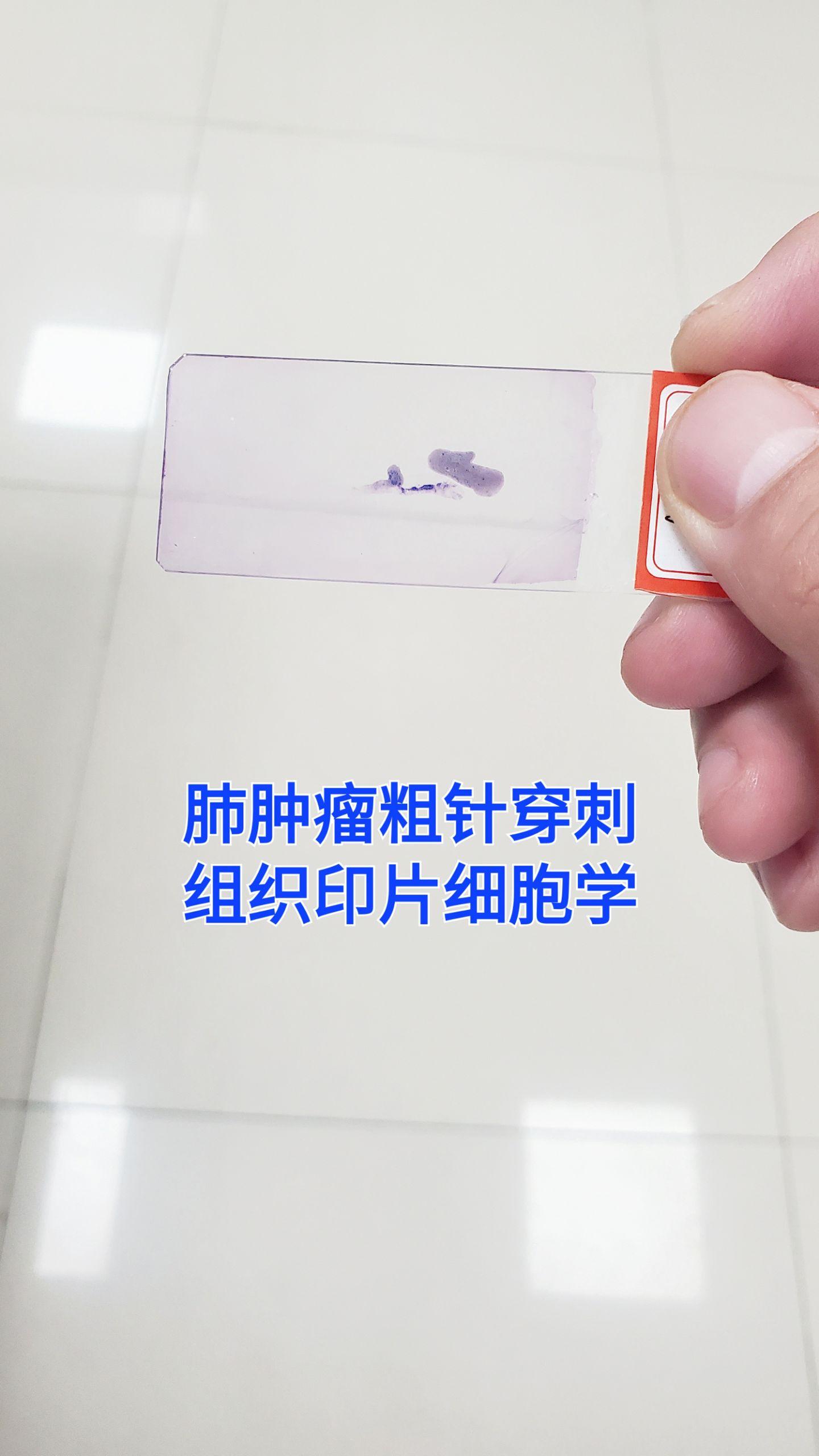 肺腺癌