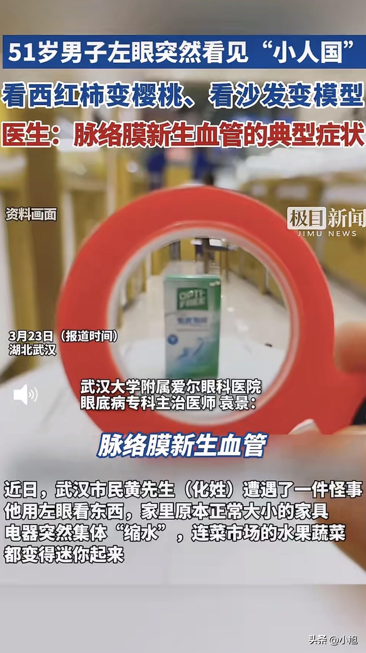 武汉一个51岁的老哥，左眼看东西，家里全变小了。

事情是一个月前开始的。

那