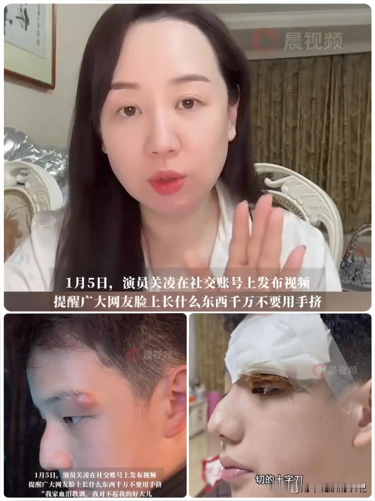 关凌给娃挤痘缝4针！家长们醒醒，这处的疙瘩真碰不得！
 
家人们谁能想到啊！明星