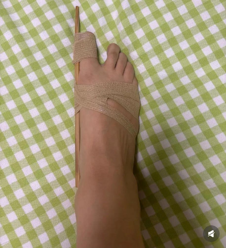 这波手工矫正能成不？
被大脚趾外翻折腾得够呛，网上矫正器评论区全是“踩坑警告”，