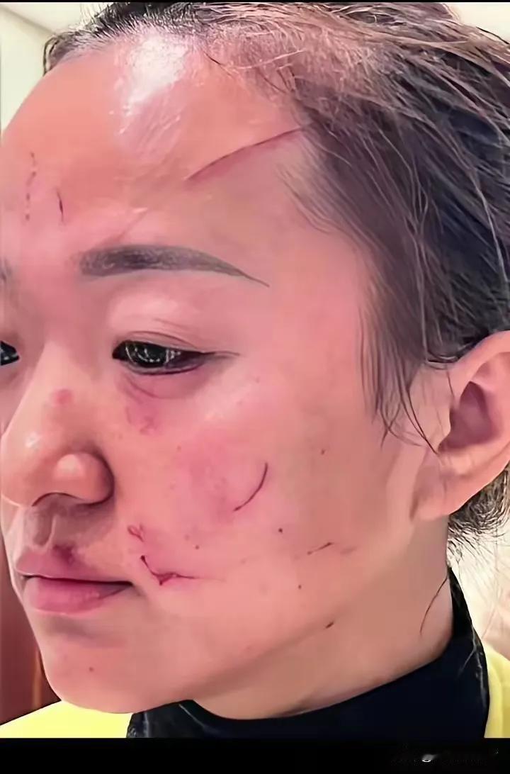 儿媳和婆婆吵得不可开交，甚至动起了手，儿媳脸上被抓出好几道血印子，看着都怕，差点