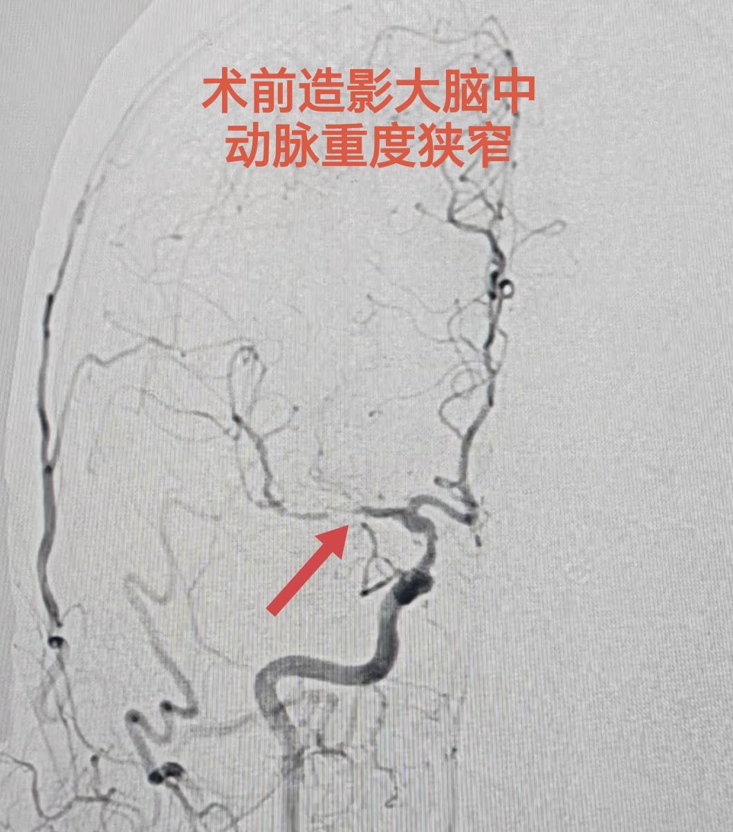 73岁，大脑中动脉重度狭窄，近期分水岭区梗塞。昨日介入行球囊扩张+支架...