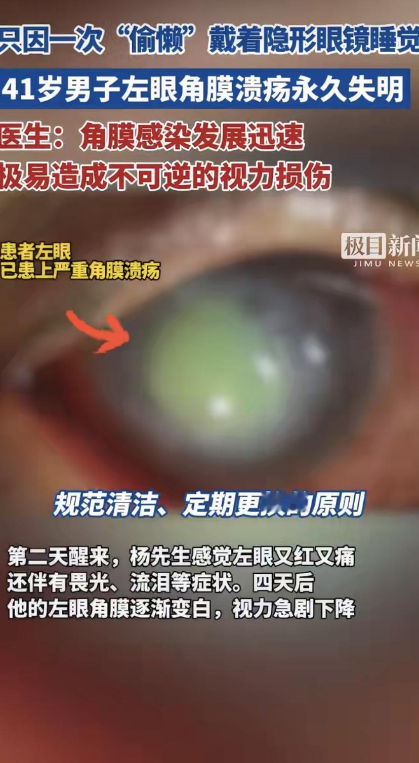 41岁大叔戴隐形眼镜偷了个懒，没摘镜就直接睡了。第二天左眼又红又疼，还怕光流泪，