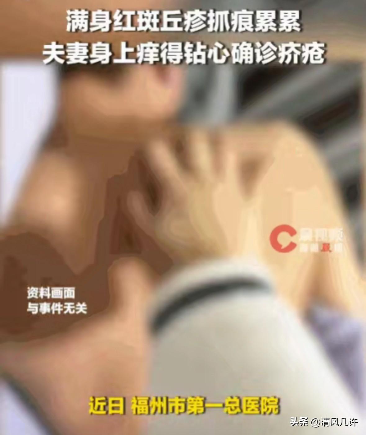 福建，一名男子在朋友家住了几天，回家后肚子、大腿痒得厉害。他以为是湿疹，天天用热