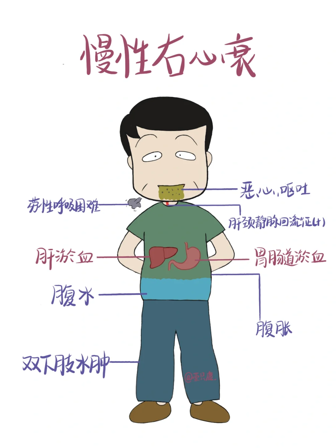 医学生笔记📒｜慢性右心衰竭🧐