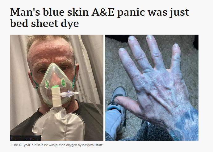 据媒体报道，英国男子Tommy Lynch一觉醒来发现自己变成了阿凡达，皮肤变蓝