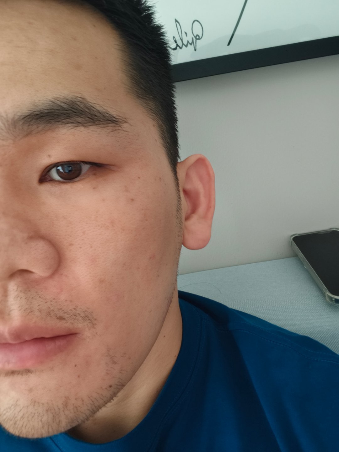 一觉醒来满脸粉刺 