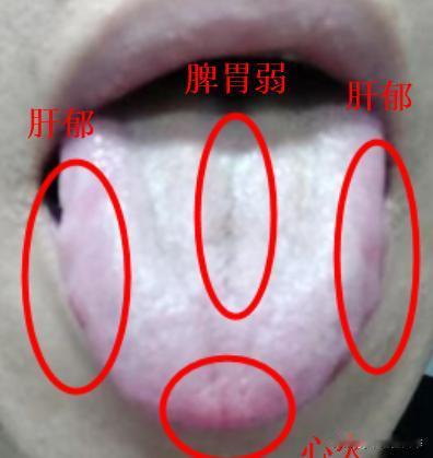评论区舌诊实战分享，这样的舌头真是让人看了就头大，阳虚、肝郁气滞、脾胃不好，湿气