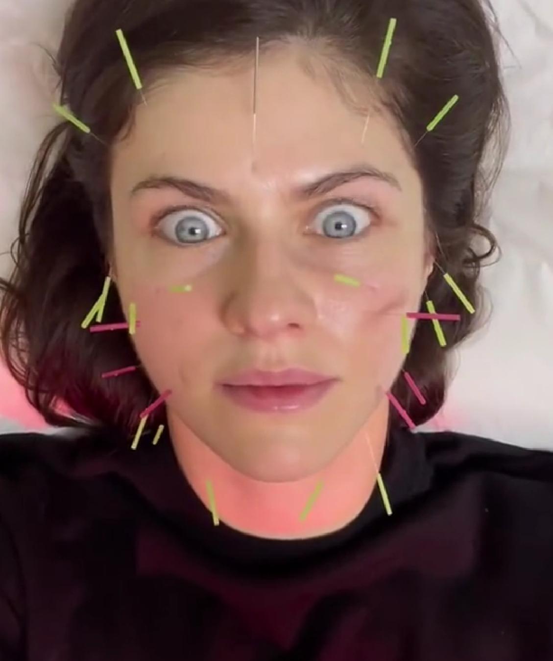 Alexandra Daddario 做面部针灸！
《致命女人》的女演员 Ale