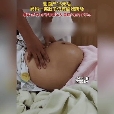 郑州一位新手妈妈王女士，坐月子时本想刷个段子解解闷，结果笑得太投入，肚子忽然鼓起