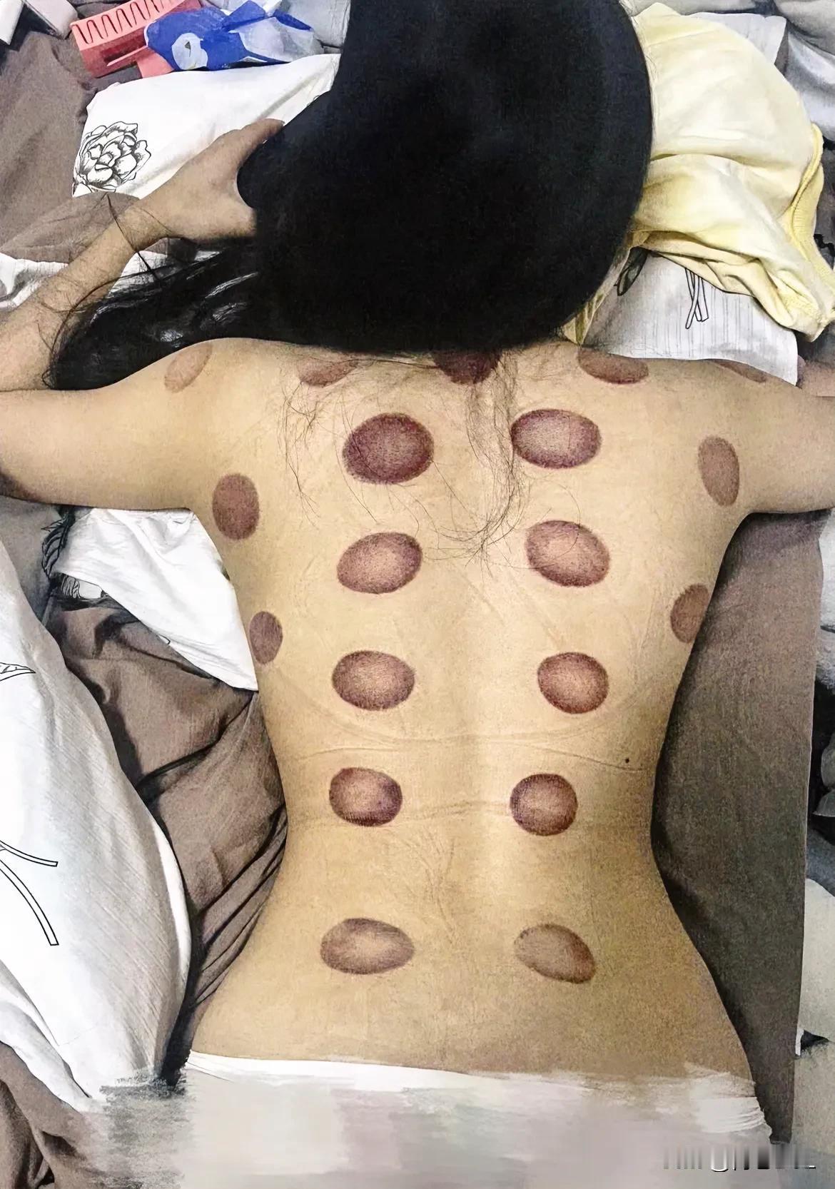 体内湿气重，在家里拔火罐，拔完火罐一身轻松！这几天持续高温，再加日常工作劳累，引
