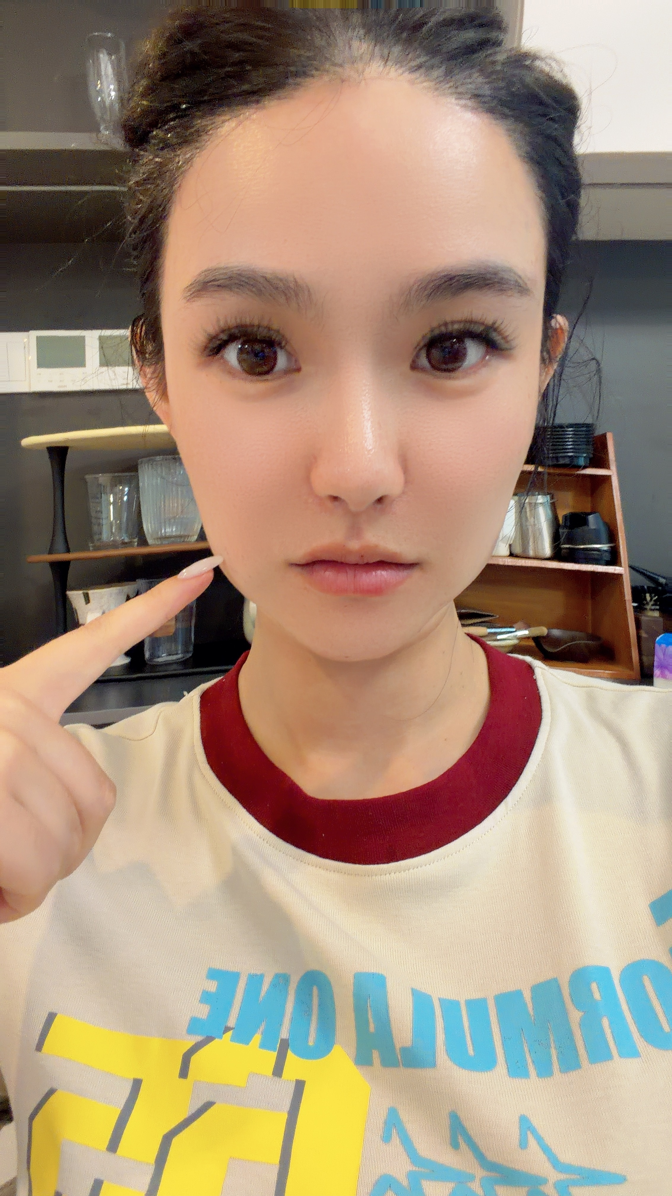 不许笑话我，我肿了！！！打了个针，变成了土拨鼠🐭 图二和我一模一样～ 合肥