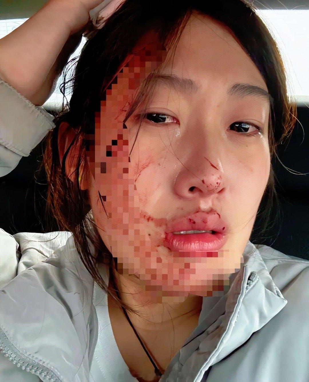 12月1日，河北一名女护士发文称：因小孩感冒输液乱动没扎好扎穿了，被小孩父亲连打