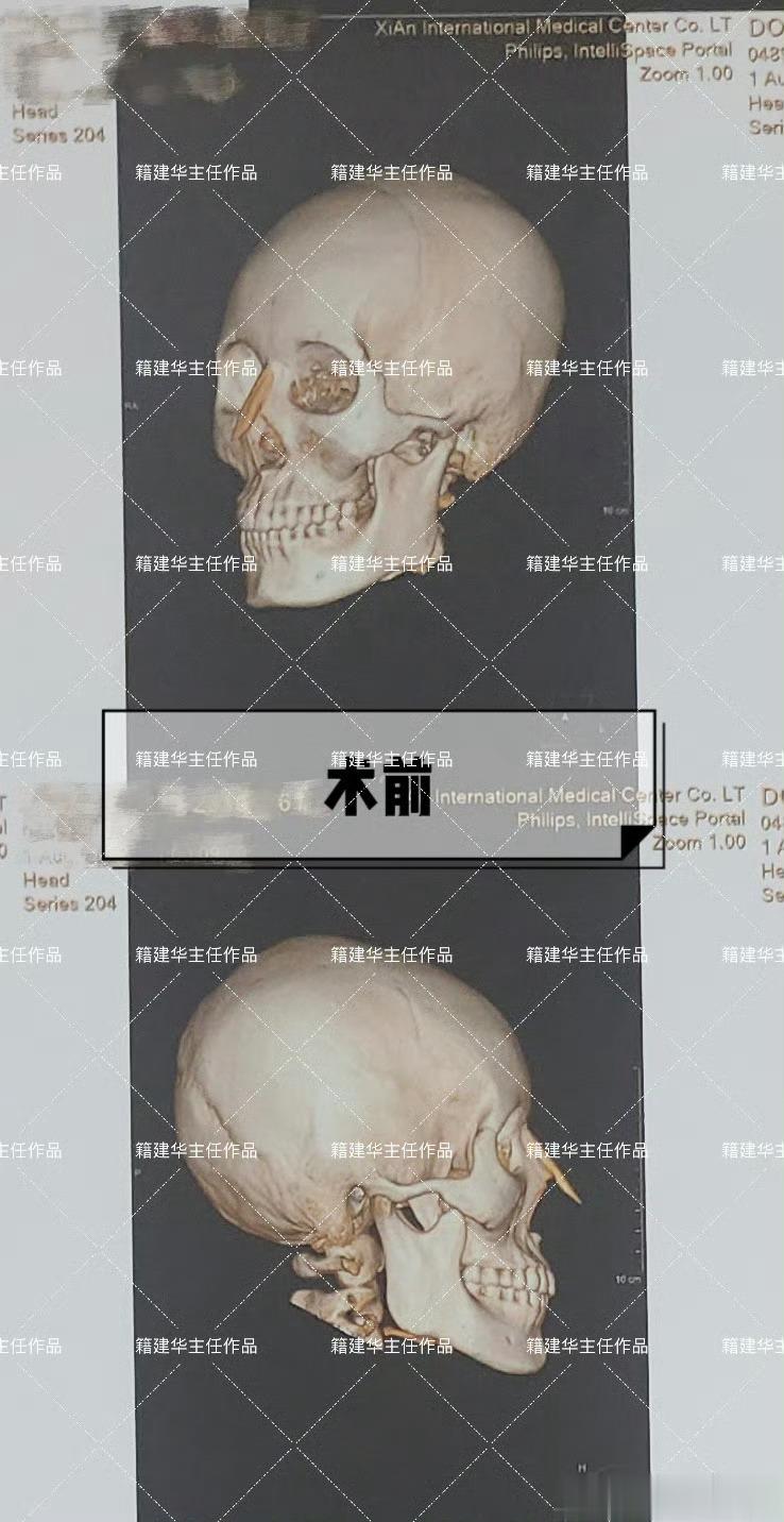 有人为下巴短而苦恼，就有人不满意自己过长的下巴😂确实是旱的旱死涝的涝死。（下巴