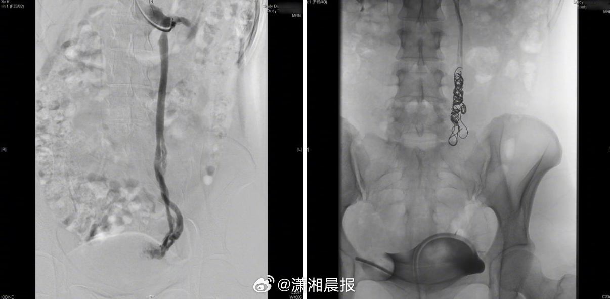 【#女子走路久站被盆腔疼痛折磨三年#，女子#性生活后盆腔痛确诊盆腔淤血综合征#】