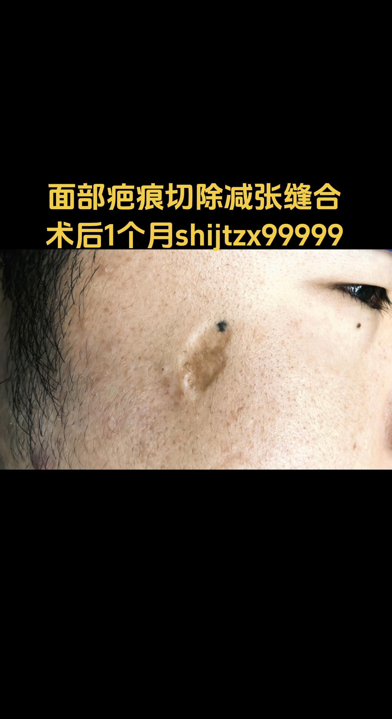 面部瘢痕。小时候面部“黑胎记”点痣后，留下瘢痕，采用整形切除适度减张缝...
