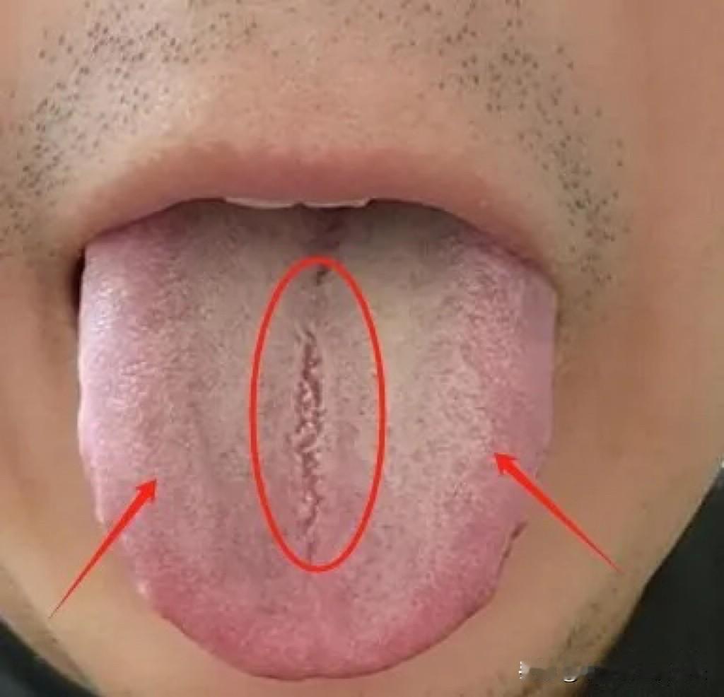 舌中有裂纹，舌苔白腻，千万不要一上来就健脾，像这样的舌象，用再多的健脾祛湿药，也