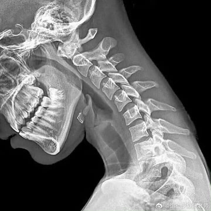 颈椎病 正在低头玩手机的你，来看你此时的颈椎[并不简单][并不简单] ​​​