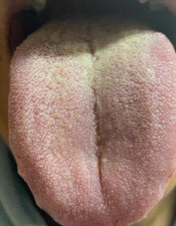 阴囊潮湿、闷热，舌头黄腻，为什么二妙丸无用？

腿根潮湿闷热、舌头黄腻厚重、宗筋