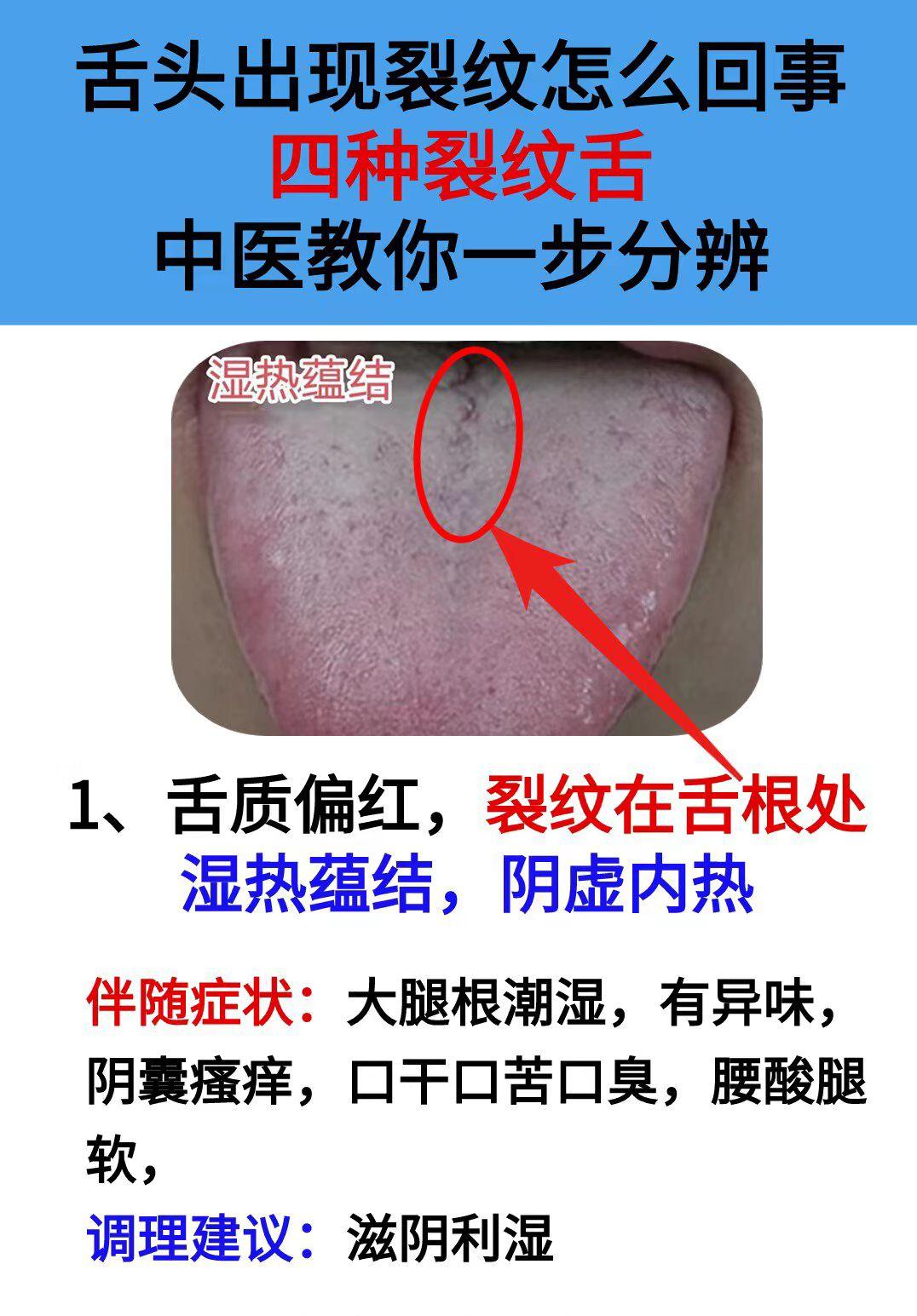 四种裂纹舌 中医教你辨证分析