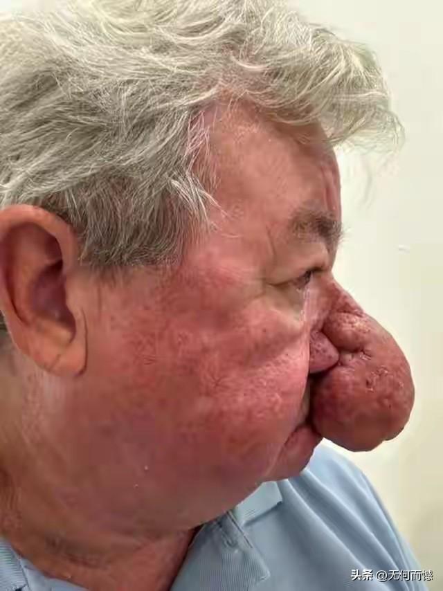 这个人的鼻子长得太特殊了，不仅长得大，而且还不好看，这应该是一种病，不知道这属不