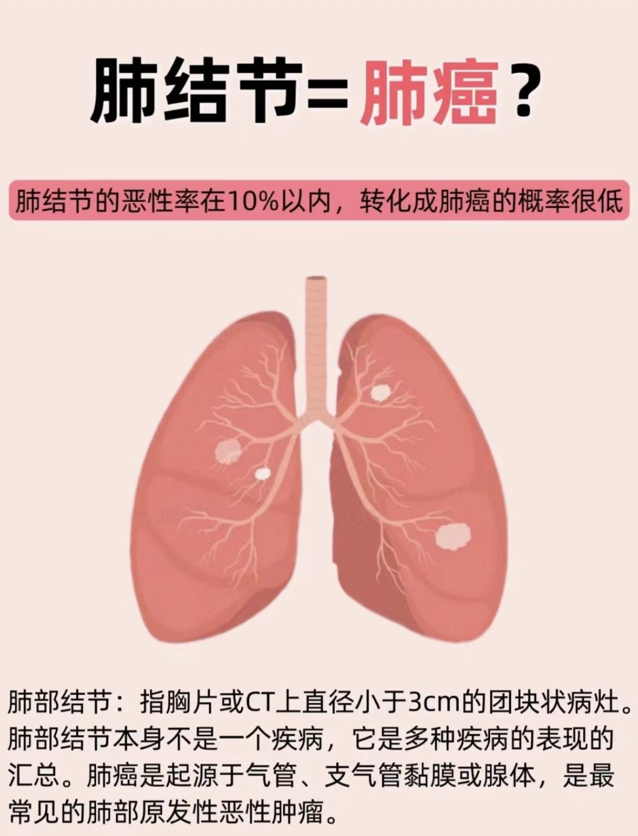 肺结节不一定就是肺癌。
