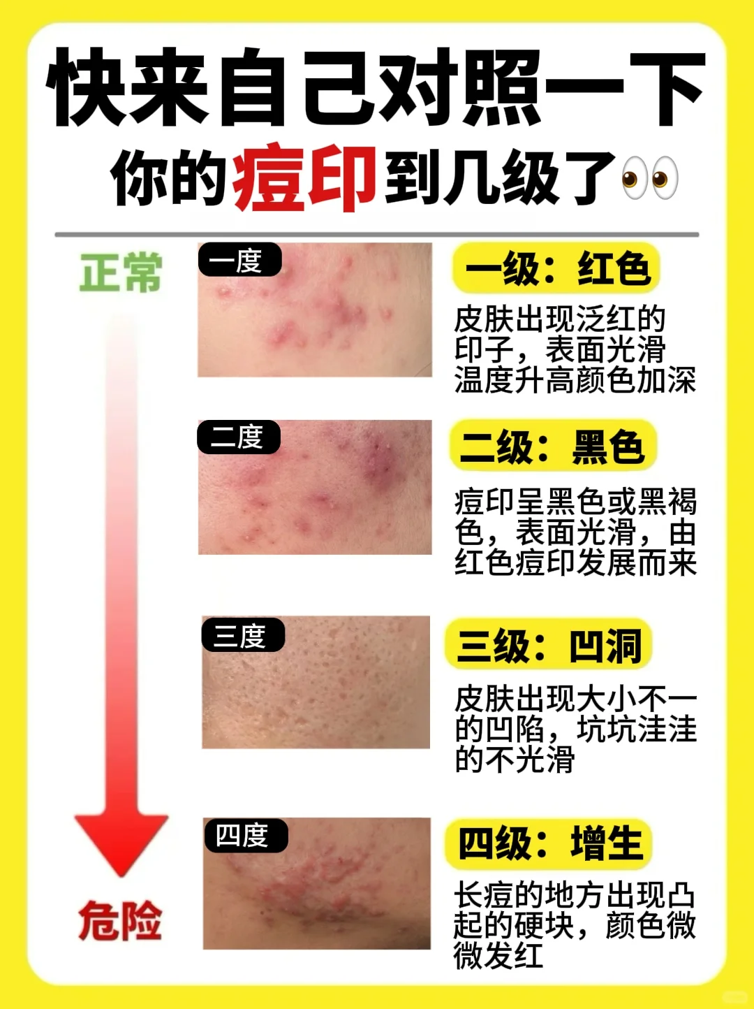 四大痘印等级⚠选对方法轻松逆袭❗